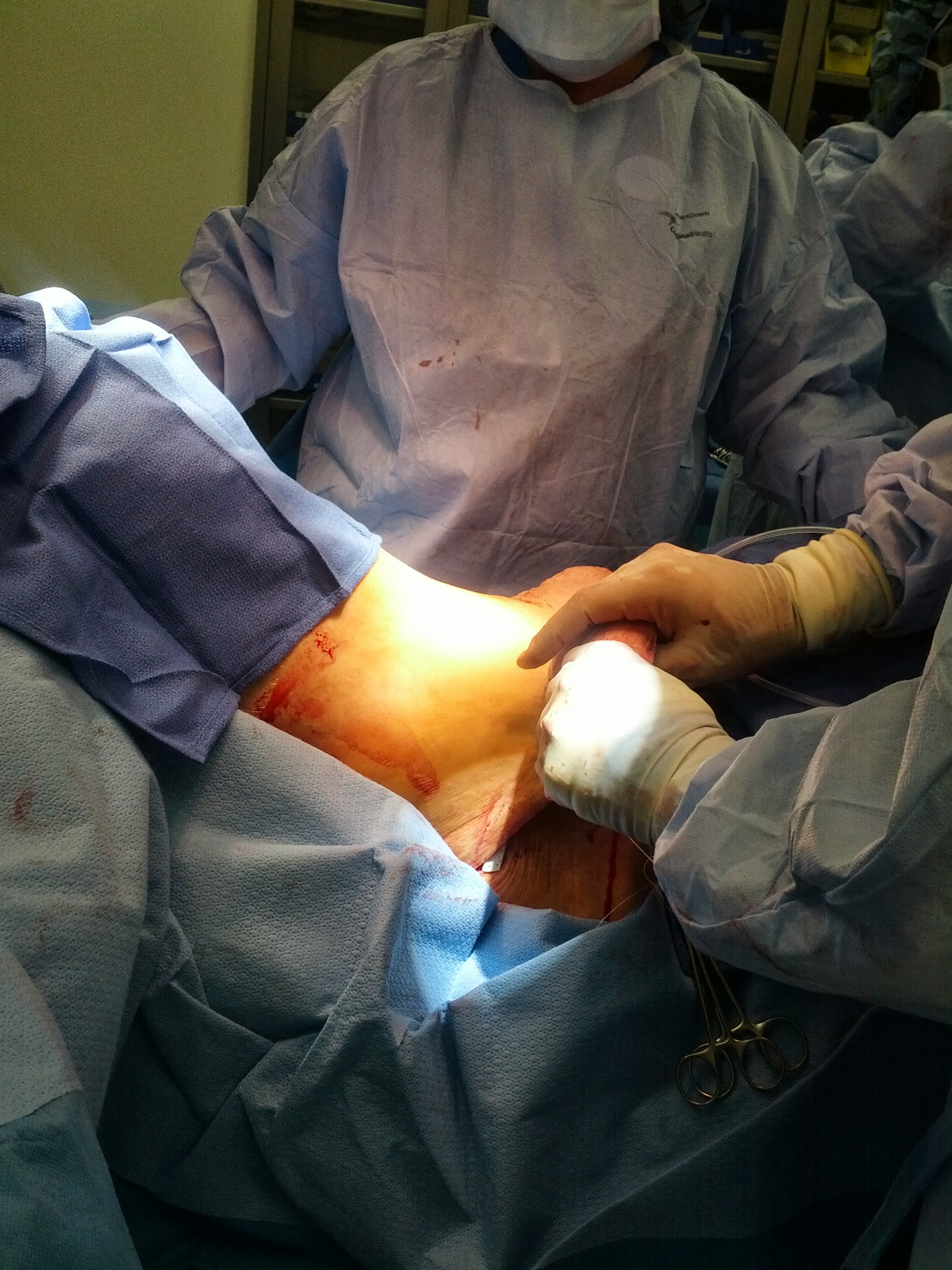 Tummy Tuck Skin Removal