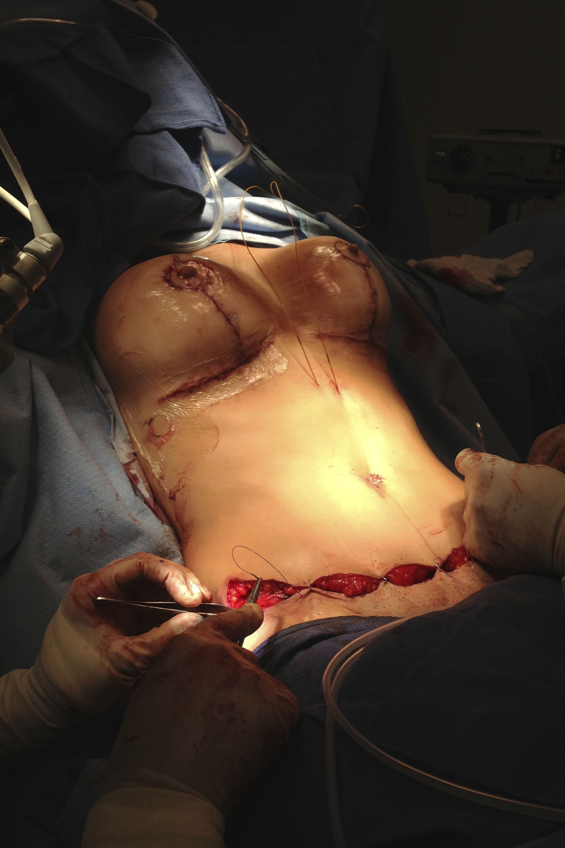 Tummy Tuck Incision