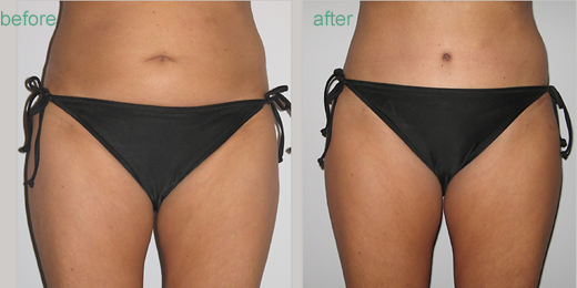 Liposuction vs. CoolSculpting®: When to Choose Each Procedure