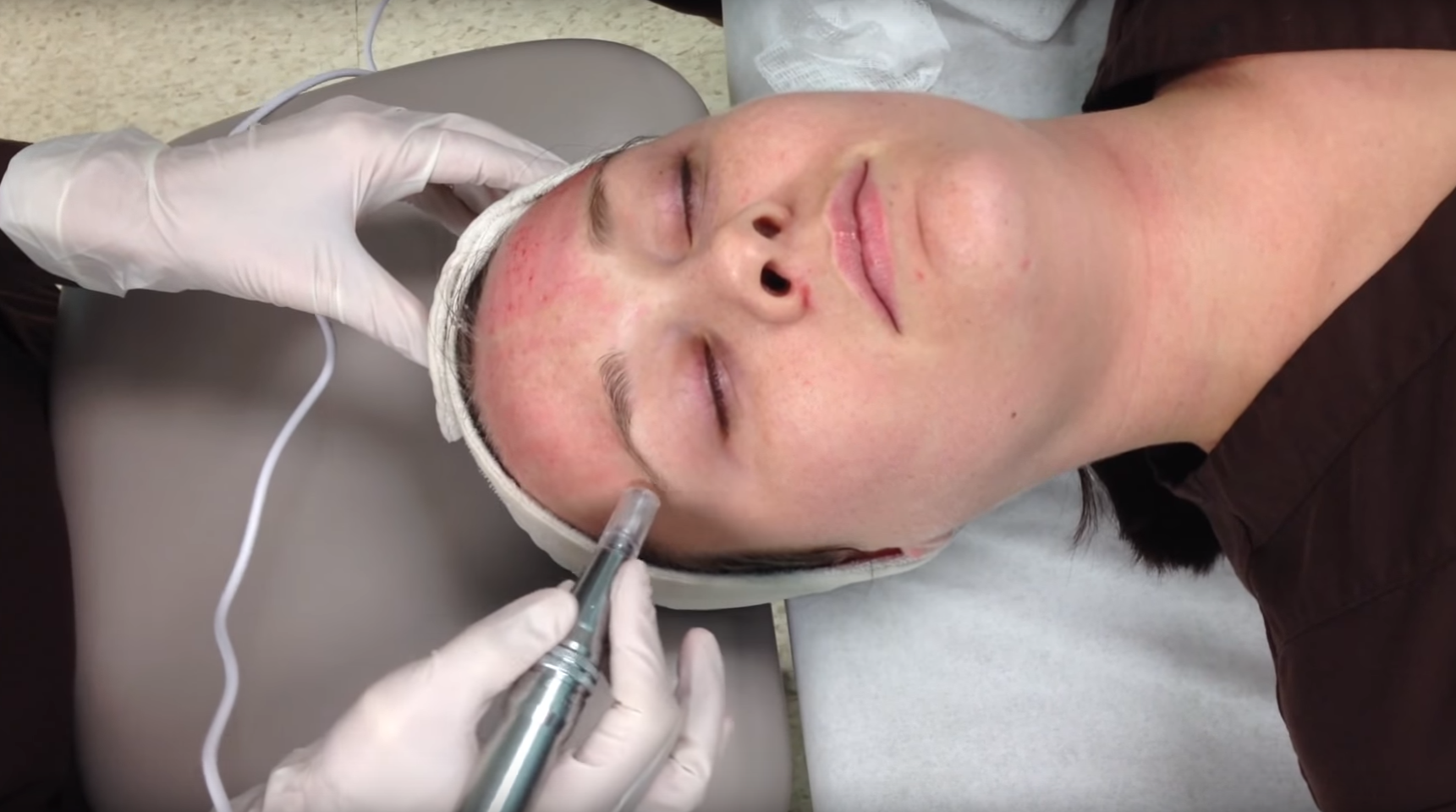 Microneedling: The Latest Facial Craze